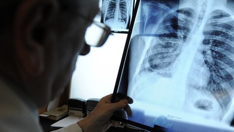 Tuberculosis incidence declines in Kyrgyzstan since early 2000s