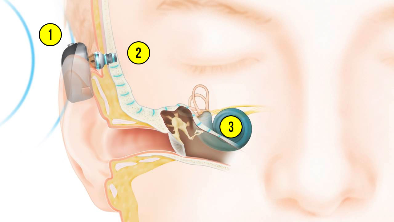Детям в Кыргызстане вручат инновационные процессоры Cochlear